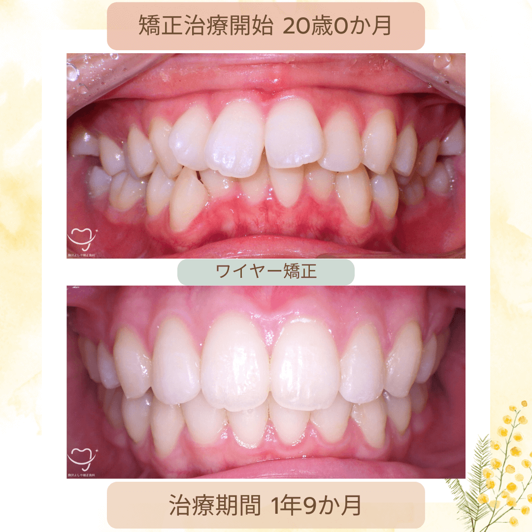 デコボコの症例