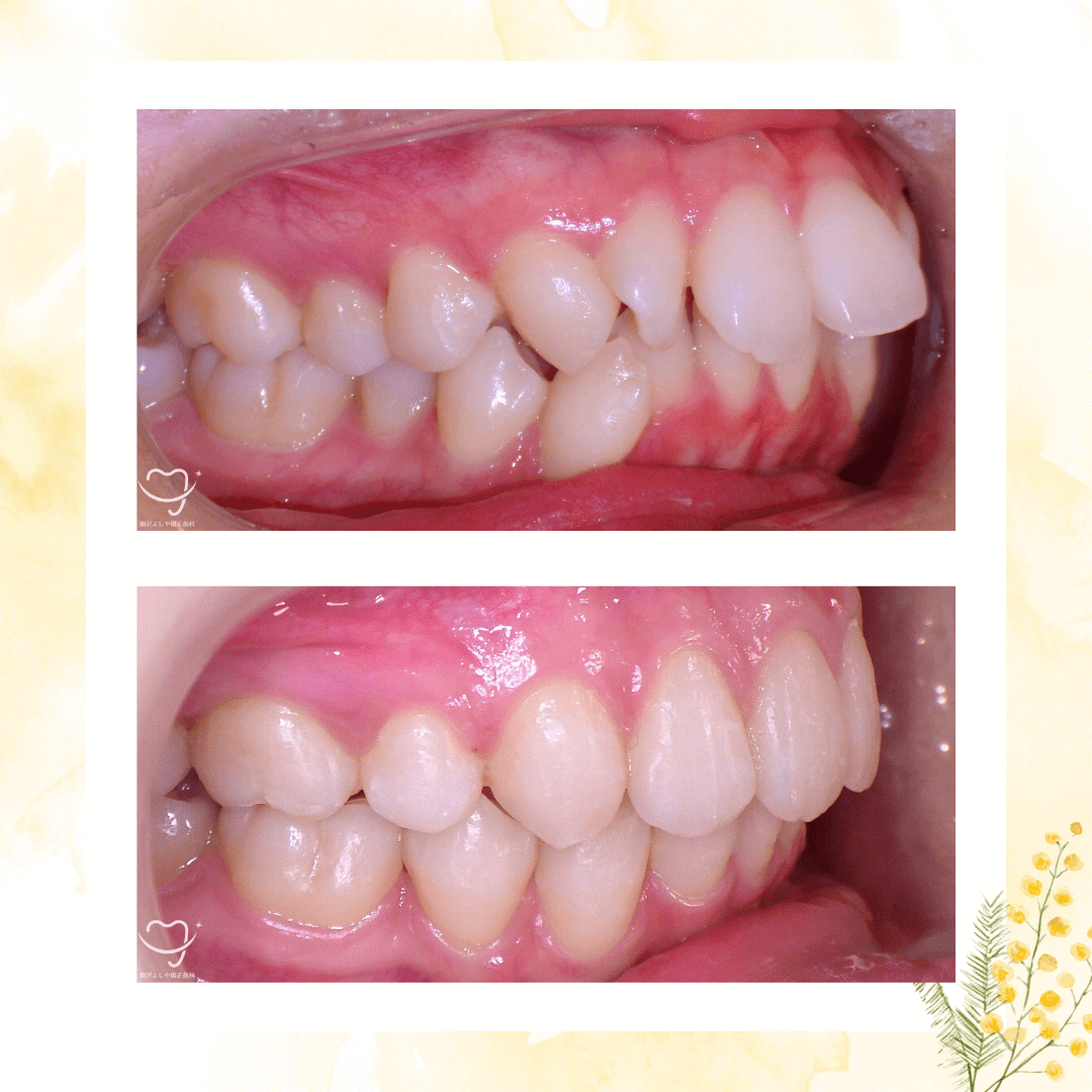 デコボコの症例