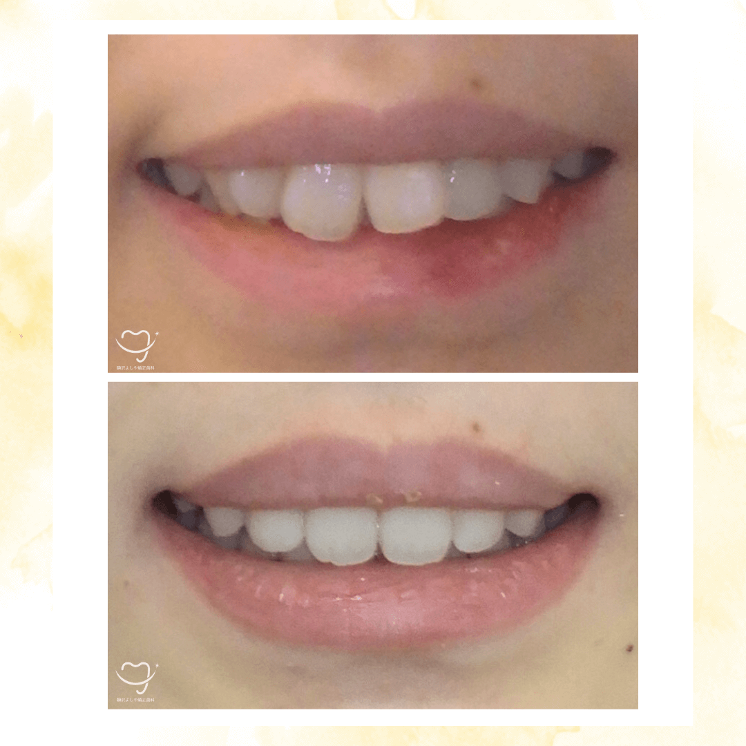 デコボコの症例