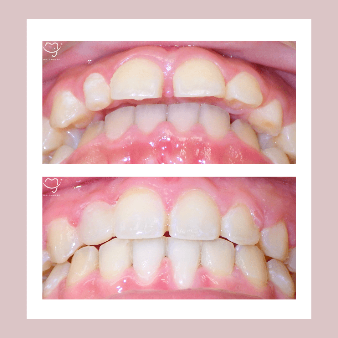 デコボコの症例