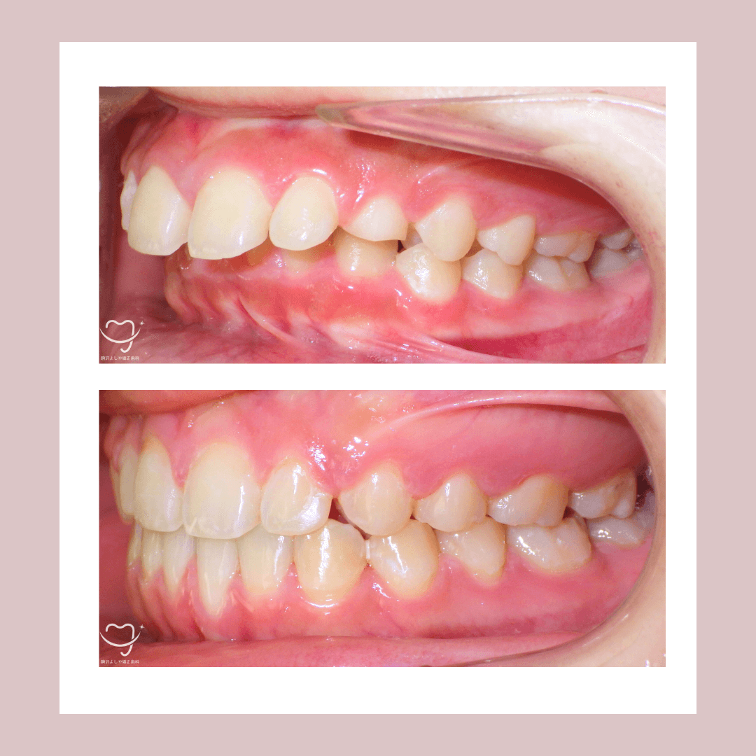 深い噛み合わせの症例