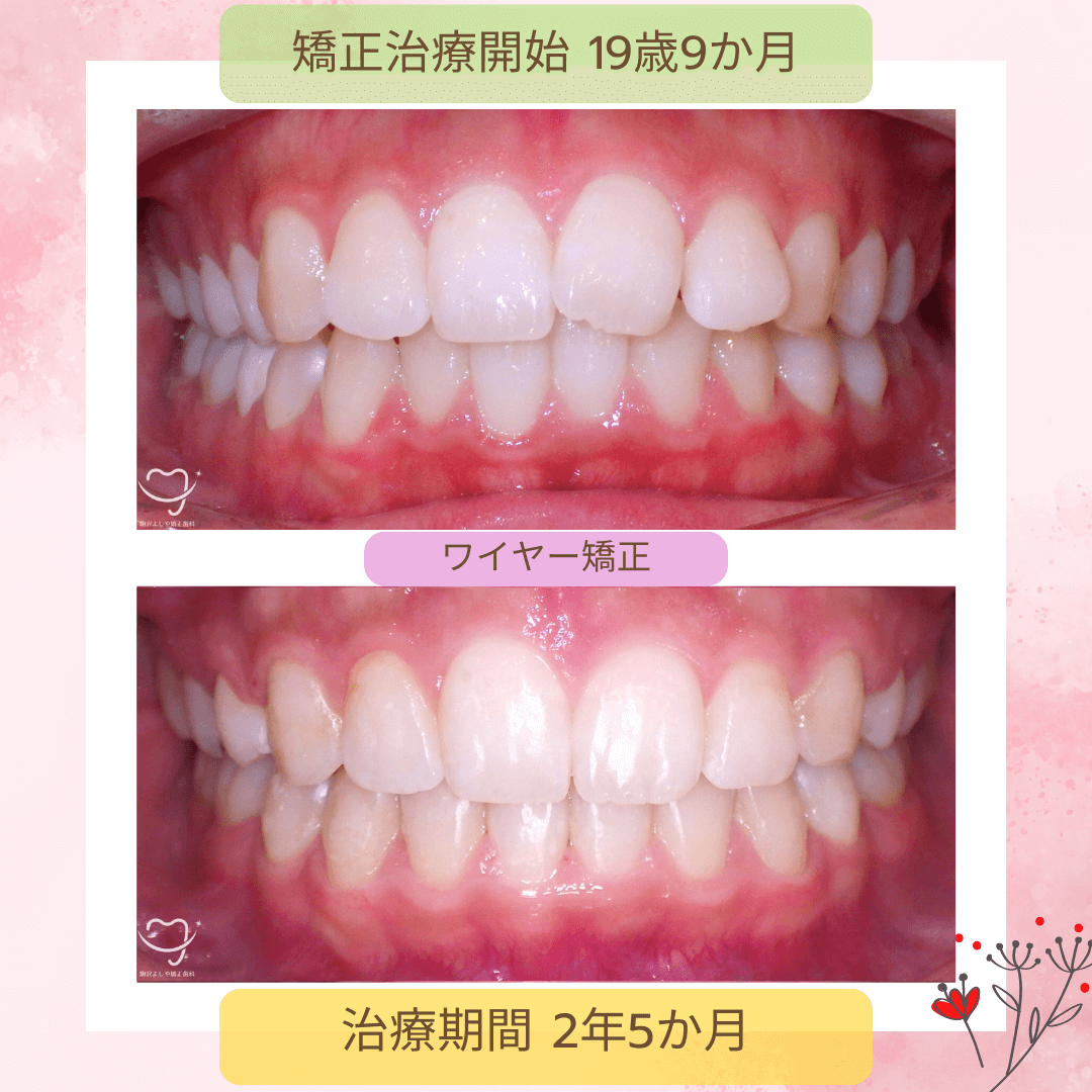 上下顎前突の症例