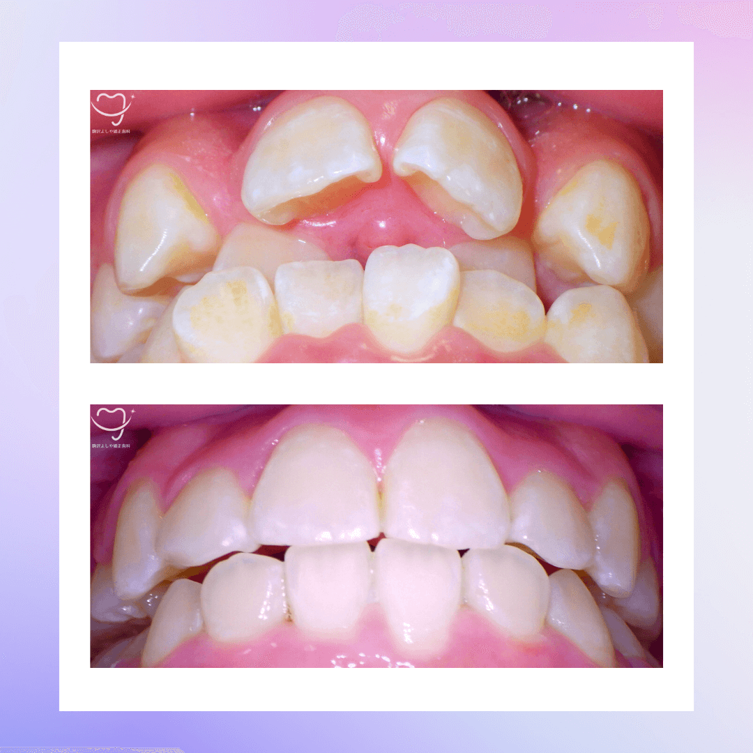 交叉咬合の症例