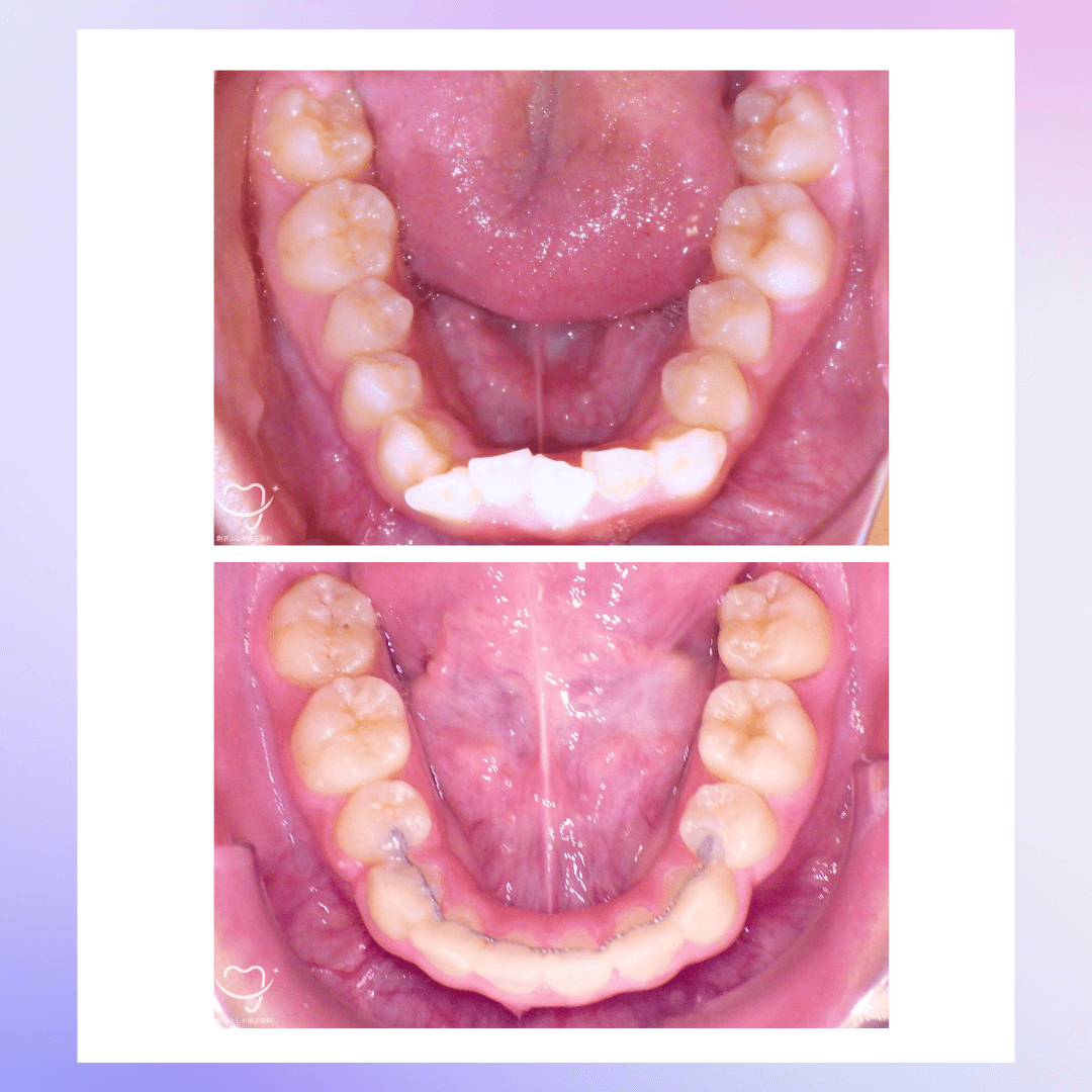 交叉咬合の症例