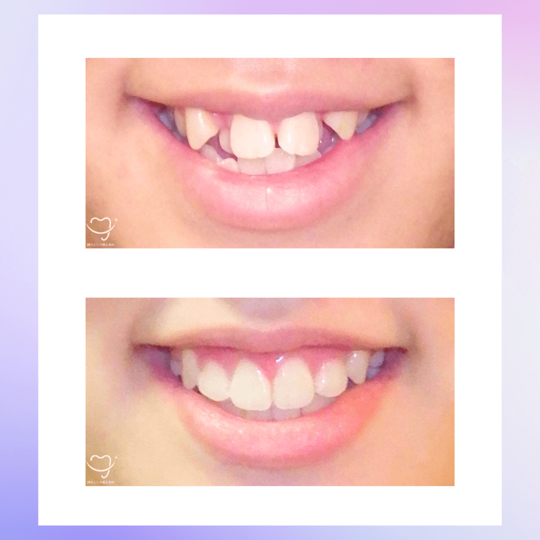 交叉咬合の症例