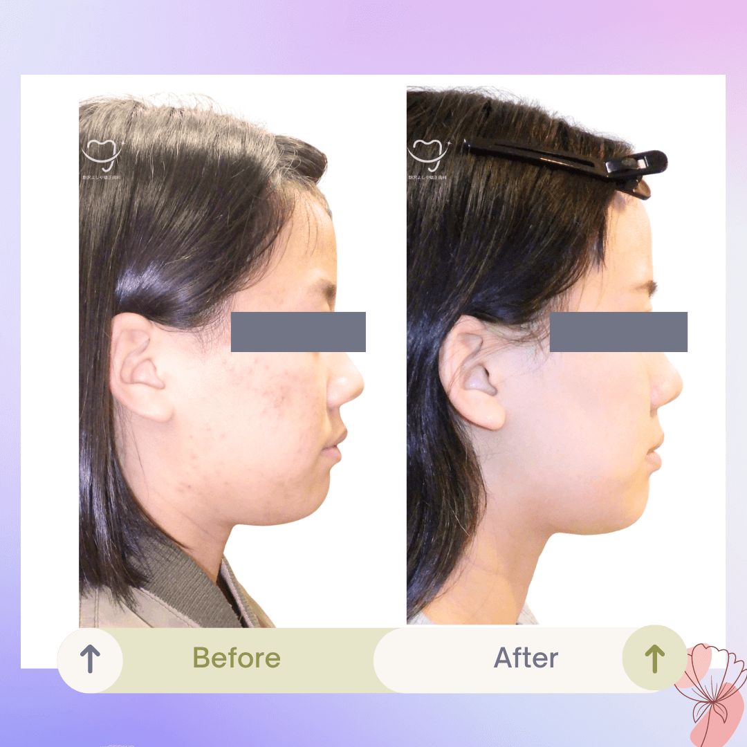 交叉咬合の症例